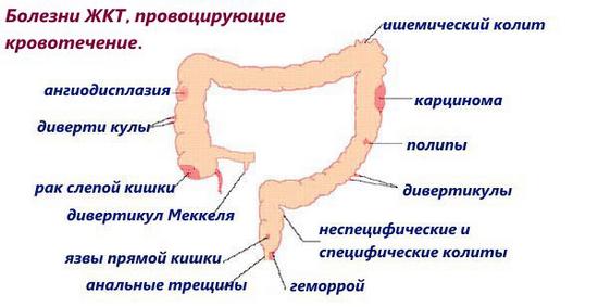 Кишкові кровотечі можуть бути ознаками таких патологічних процесів: