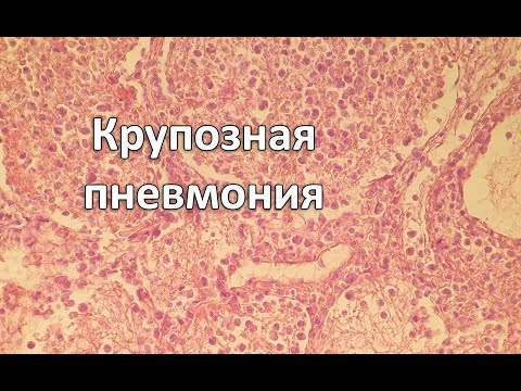 Крупозна пневмонія |  патанатомія