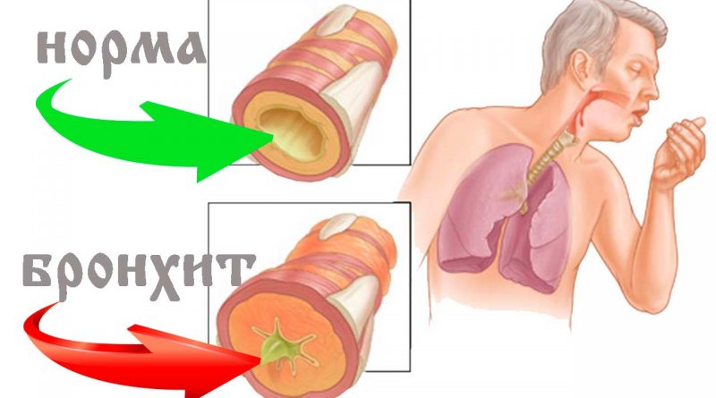 Лікування прополісом бронхіту