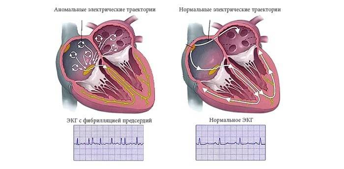 Персистирующая миготлива аритмія відрізняється тим, що для її купірування необхідне втручання лікарів