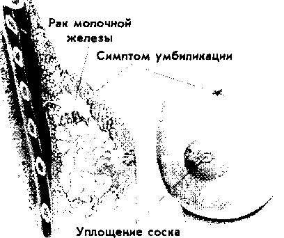 При натягу цих зв'язок утворюється западіння, яке іноді можна бачити над злоякісними утвореннями молочної залози