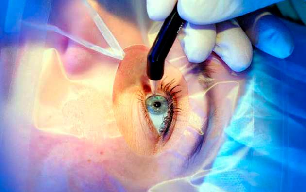 Лазерна корекція зору LASIK неспроста набула такої популярності в сучасному суспільстві