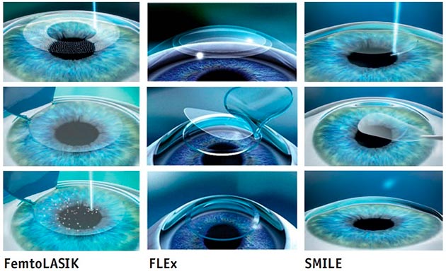Операція, проведена за допомогою ексимерного лазера, включає в себе кілька етапів