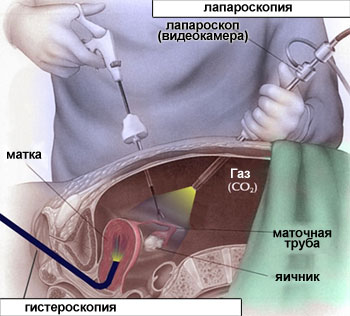 Якщо є можливість, проводять лапароскопію