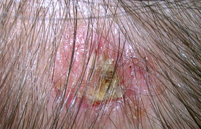 Карциноми базальних клітин можуть також утворюватися на волосистій частині голови, тому важливо щомісяця відвідувати дерматолога і перевіряти шкіру голови на наявність новоутворень або наростів
