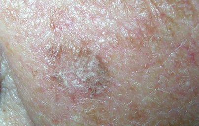 Плоскоклітинний рак шкіри може виявлятися у вигляді червонуватих або коричневих плям на шкірі, часто з грубої, лускатої або кострубатою поверхнею
