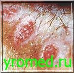 Симптомами венеричних хвороб можуть бути різні види висипу в області статевих органів і на всьому тілі, особливо супроводжувані сверблячкою, також ерозії, виразки, кондиломи, папіломи, бородавки, бульбашки і т