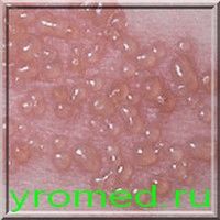 Необхідно пам'ятати, що венеричні хвороби, в типовому прояві, мають гостру і хронічну стадію