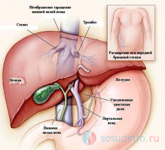 Під ущільненням судин печінки, в першу чергу, мають на увазі патологічні зміни стінок синусоїдногокапілярів