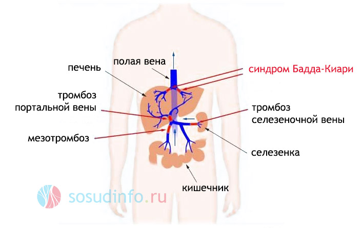 );   Хвороби печінки і, зокрема, цироз