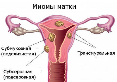 Тому місячні протікають важко, зі значною крововтратою