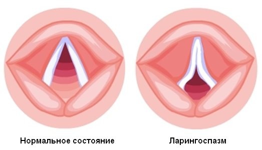 Спазми в горлі - симптом неспецифічного характеру, який може свідчити як про захворювання отоларингологічного характеру, так і про інших патологічних процесах в організмі