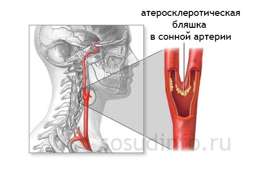 У рідкісних випадках вона може повністю закривати просвіт судини або відриватися від стінки і мігрувати по судині, викликаючи ряд серйозних ускладнень