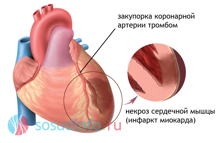 симптоми   інфаркту міокарда   знайомі багатьом: інтенсивний біль в області серця, задишка, відчуття страху смерті, ціаноз, порушення ритму серця і інші