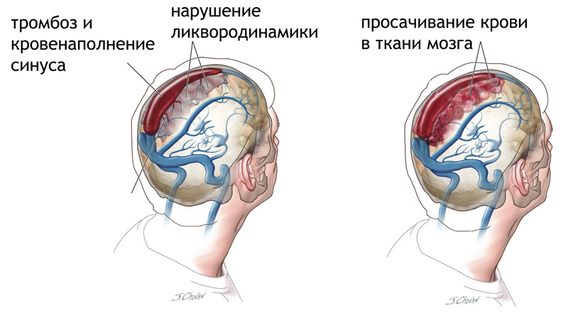 Оскільки спинномозкова рідина виводиться через сплетення мозкових синусів, то при перекритті присвятив останніх часто виникає блокада ликвородинамики з різким збільшенням внутрішньочерепного тиску