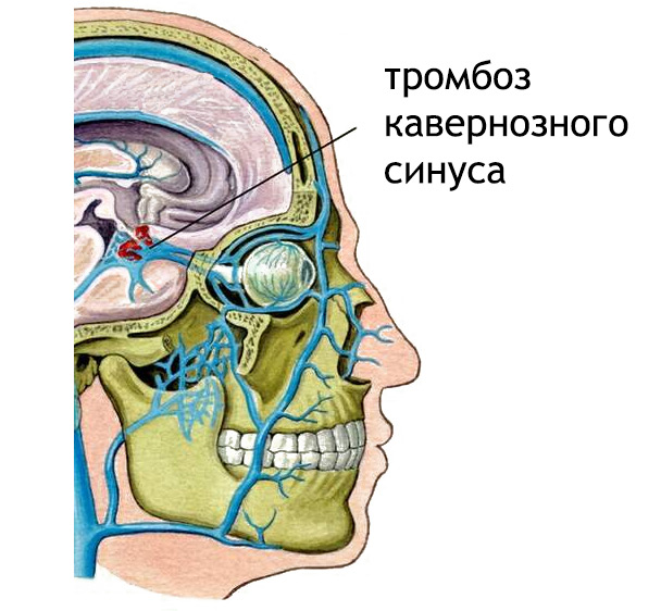 Септичний тромбоз, крім неврологічної симптоматики, буде супроводжуватися сильною інтоксикацією, коливаннями температури тіла від дуже високої до (раптово) нормальної, ознобом і рясним пітливістю, можливий марення, сопор і кома