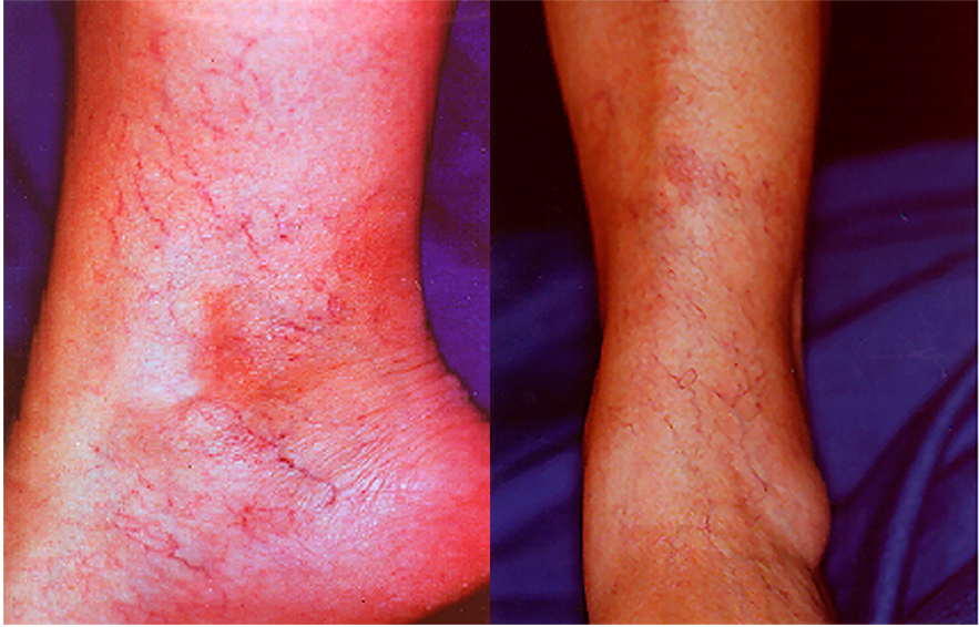 іноді,   телеангіоектазії   і ретикулярні вени помилково приймають за варикозно-розширені