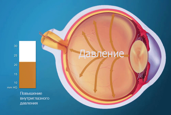 Різновид може виникати в ході променевої терапії зорового апарату