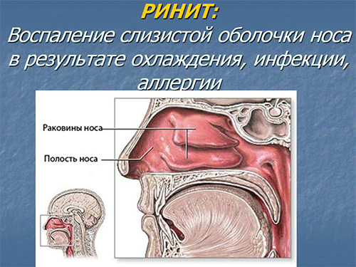 Для деяких поточний ніс стає супутником по життю, заважає нормально жити і працювати