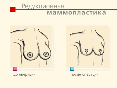 Підтяжка грудей (мастопексія) - хірургічна операція, що проводиться з метою зміни зовнішнього вигляду молочних залоз