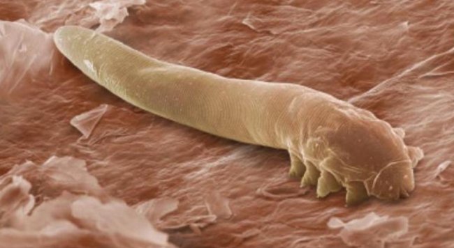 Демодекс на обличчі: у чому підступ хвороби, як від неї позбутися