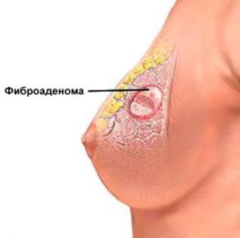 Клінічні прояви фіброаденом