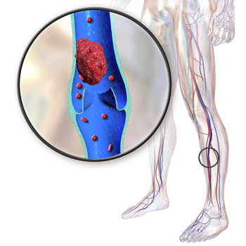 Зупинка кровотоку тромбом