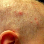Симптоми на різних частинах голови однакові: починається сверблячка на голові, іноді піднімається   температура   до 39 градусів, головний біль, погіршення самопочуття, слабкість і занепад сил, втрата апетиту, нудота, запалення лімфатичних вузлів голови і   шиї   , Лор - захворювання