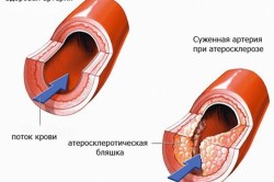 Якщо початку часто боліти голова, з'явилися запаморочення і шум у вухах, який не дозволяє розпізнати мову співрозмовника, чоловік почав забувати слова і плутати імена і назви речей, - варто задуматися, адже це і є найчастіше зустрічаються ознаки атеросклеротичного ураження стінок судин головного мозку