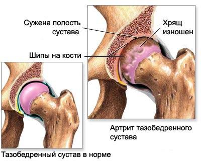 в разі застою крові і підвищення внутрішньокісткового тиску при варикозному розширенні вен - нічні болі ( «суглобова мігрень»)