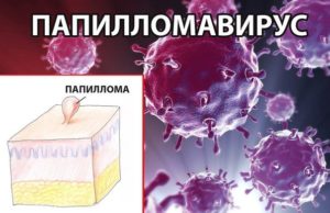 Клінічні прояви шкірної папіломавірусної інфекції різноманітні, і груди - не є винятком