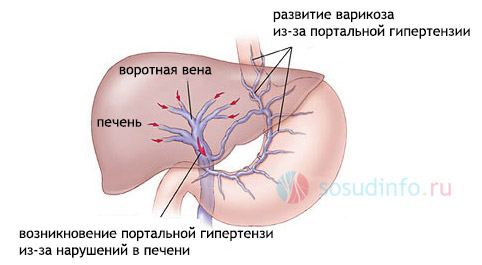 portaе часто відзначається у дітей, як результат внутрішньочеревної інфекції (або пупкового сепсису) новонароджених, або - незалежно від віку, при інфекційних хворобах органів травлення