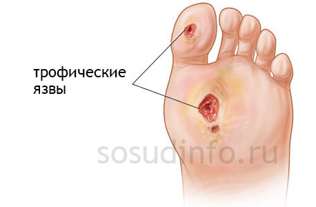 Венозні виразки;   Виразки артеріальні (атеросклеротичні);   Виразки діабетичні (на тлі   цукрового діабету   );   Нейротрофічні, пов'язані з черепно-мозковими травмами або ушкодженнями хребта;   Виразки Марторелла або гіпертонічні;   Піогенні (інфекційні)