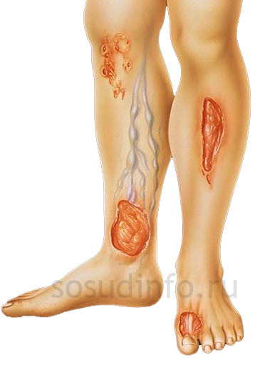 Цей різновид трофічних виразок формується в основному на гомілки, в нижній частині її внутрішньої поверхні