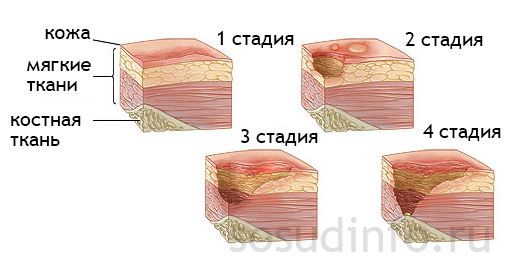 На завершення початкової стадії з'являються струбцини білястого кольору, що нагадують парафінові пластівці