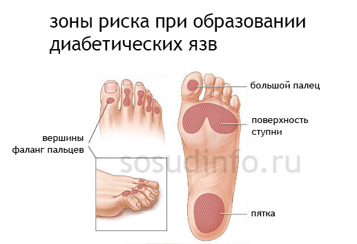 Цукровий діабет - захворювання, яке дає безліч різних ускладнень, одним з них є діабетична трофічна виразка