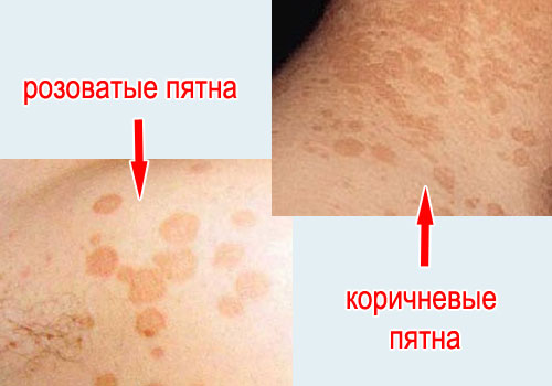 На фото: плями на шкірі при лишаї