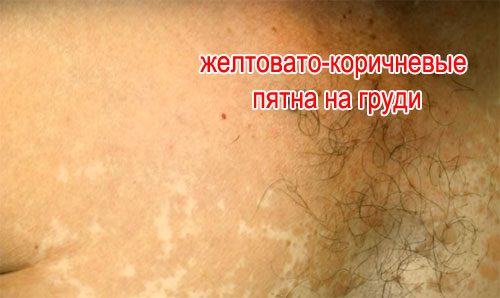 На фото: плями зливаються в конгломерат