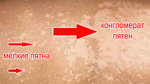 На фото: білі плями на шкірі спини