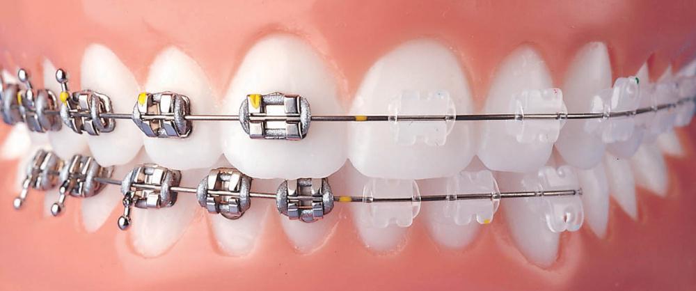 З огляду на, що чистка зубів при наявності брекетів утруднена, стає зрозумілим, чому через деякий час зуби і брекети покриваються м'яким нальотом, який негативно позначається на кольорі