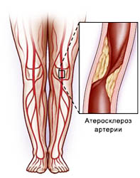 Існує комплекс факторів, що сприяють атеросклеротичного ураження судин, в тому числі і артерій нижніх кінцівок