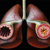 Профілактика бронхіальної астми   - З огляду на принципи розвитку захворювання, розрізняються два типи захворювання: інфекційно-алергічна і алергічна