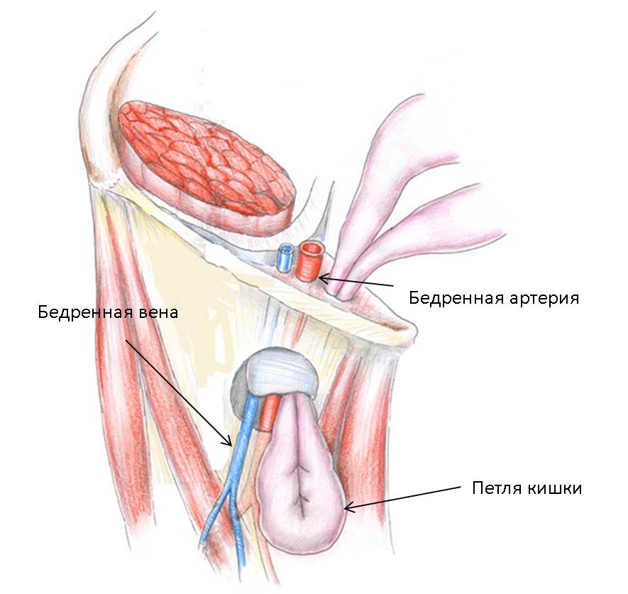 Стегнова грижа являє собою випинання внутрішніх органів через стегновий канал