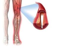 Ішемія нижніх кінцівок - це ослаблення кровообігу в нижніх кінцівках, обумовлене закупоркою (окклюзией) або звуженням артерій