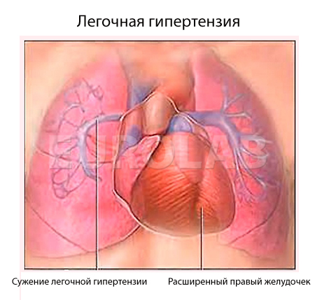 гиповентиляционная синдром   висотна гіпоксія   хронічні обструктивні захворювання легень