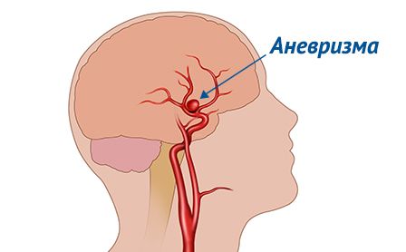 Аневризма судин головного мозку - це розширення або випинання стінки мозкової артерії