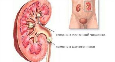Сечокам'яна хвороба (уролітіаз) - це захворювання, яке характеризується утворенням каменів в сечовивідних органах