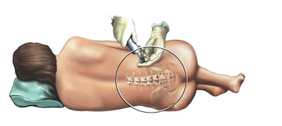 Спинномозкова анестезія - все більш популярний метод знеболення