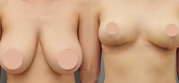 Мастопексия - це пластична операція на молочних залозах, яка виконується з метою підтяжки грудей