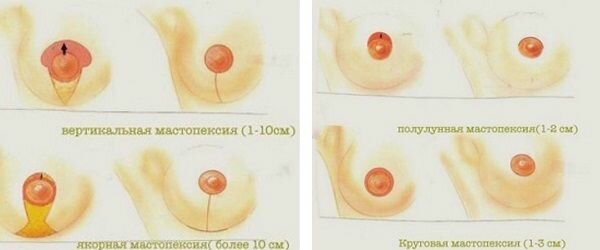 Перераховані вище види мастопексії відносяться до так званим класичним способам підтяжки грудей